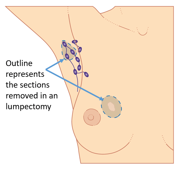 Graphical representation of sections removed during a lumpectomy.