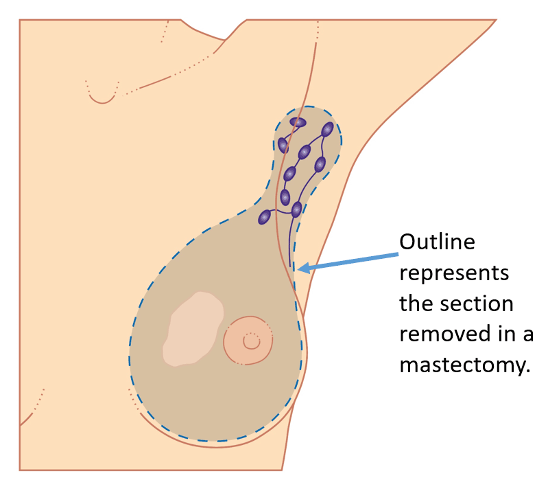 Graphical representation of sections removed during a mastectomy.
