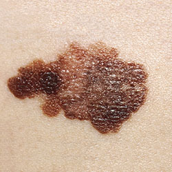 cancerous mole with irregular shape and borders with discoloration