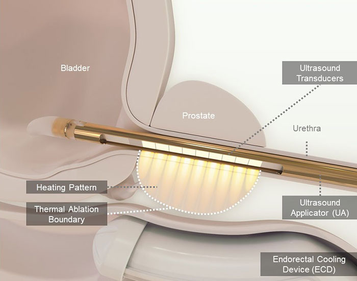 Diagram showing the device in the prostate, indicating bladder, urethra, ultrasound transducers, heating pattern, thermal ablation boundary, ultrasound applicator (UA), endorectal cooling device (ECD)